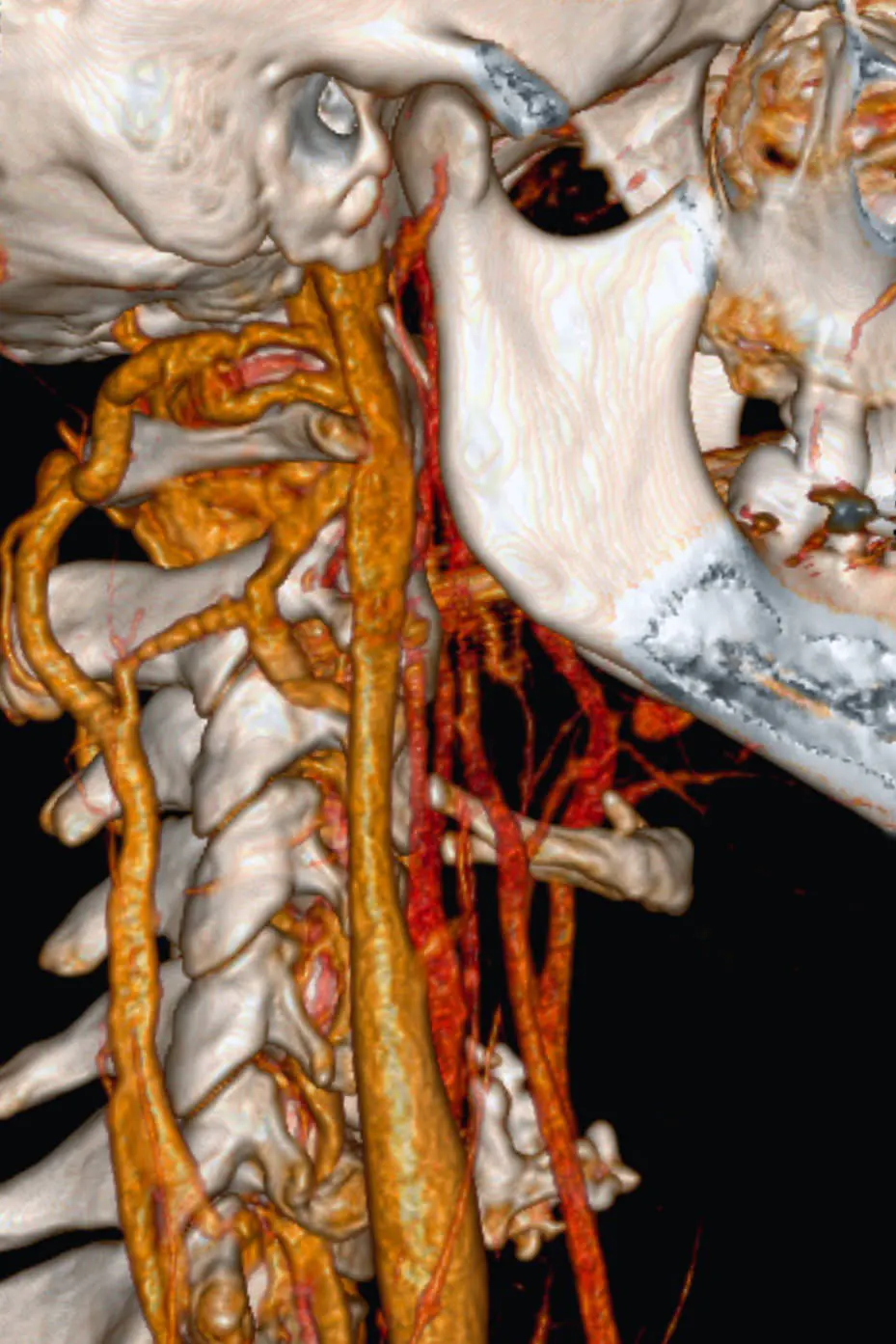 TC angiografia cervicale