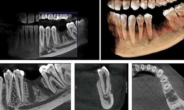 Cone Beam della mandibola