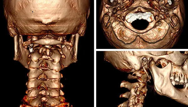 Tomografia cervicale