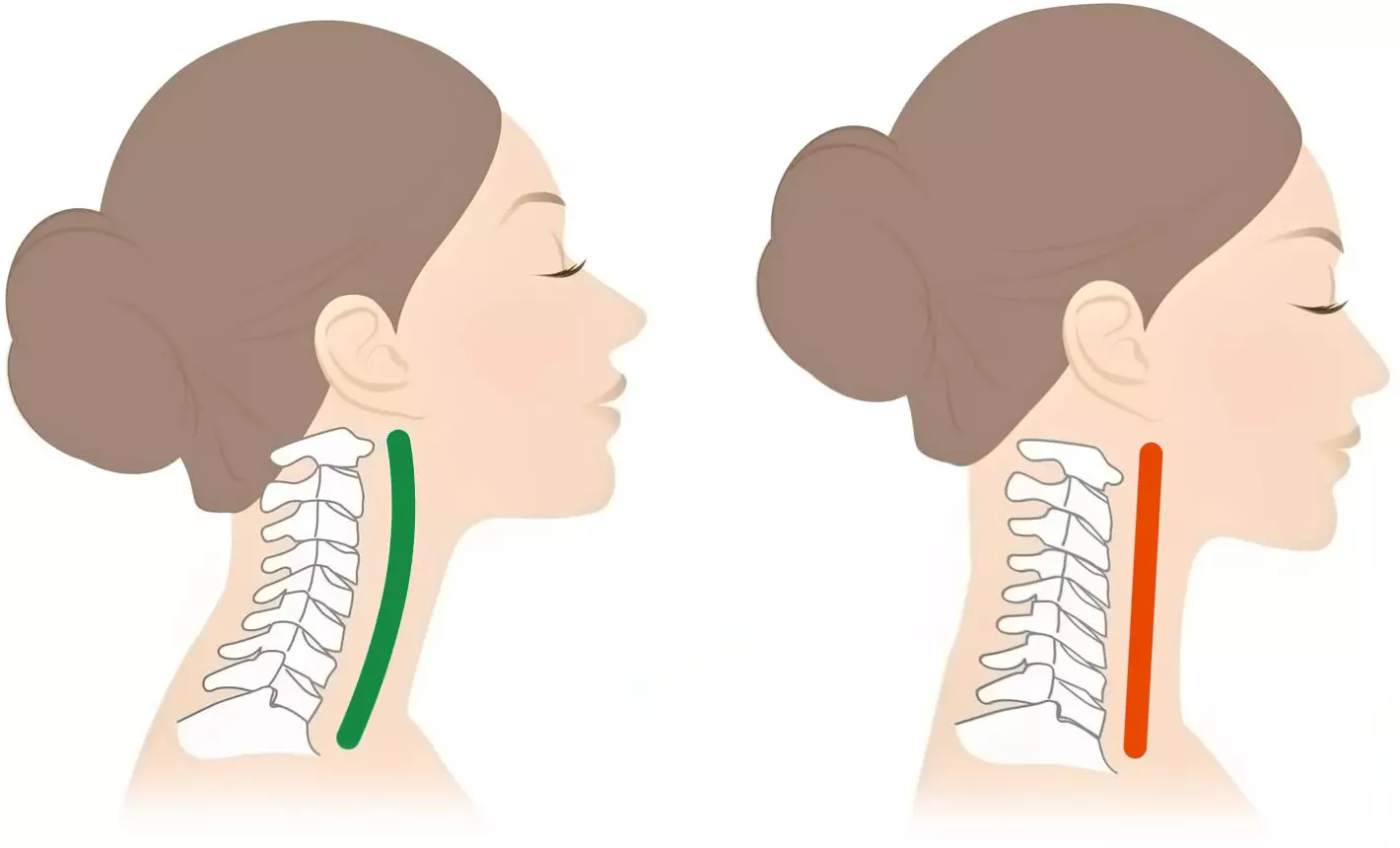 Rettilineizzazione del rachide cervicale