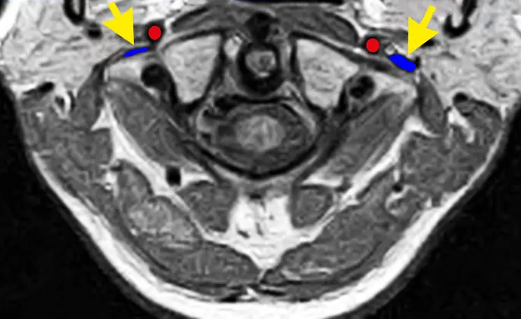 Risonanza magnetica vertebra Atlante compressione vena giugulare