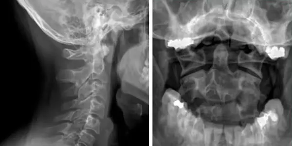 Radiografia cervicale e intraorale