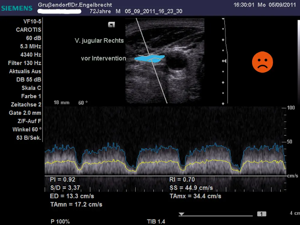 Immagine ecografica della vena giugulare compressa prima della correzione dell'Atlante