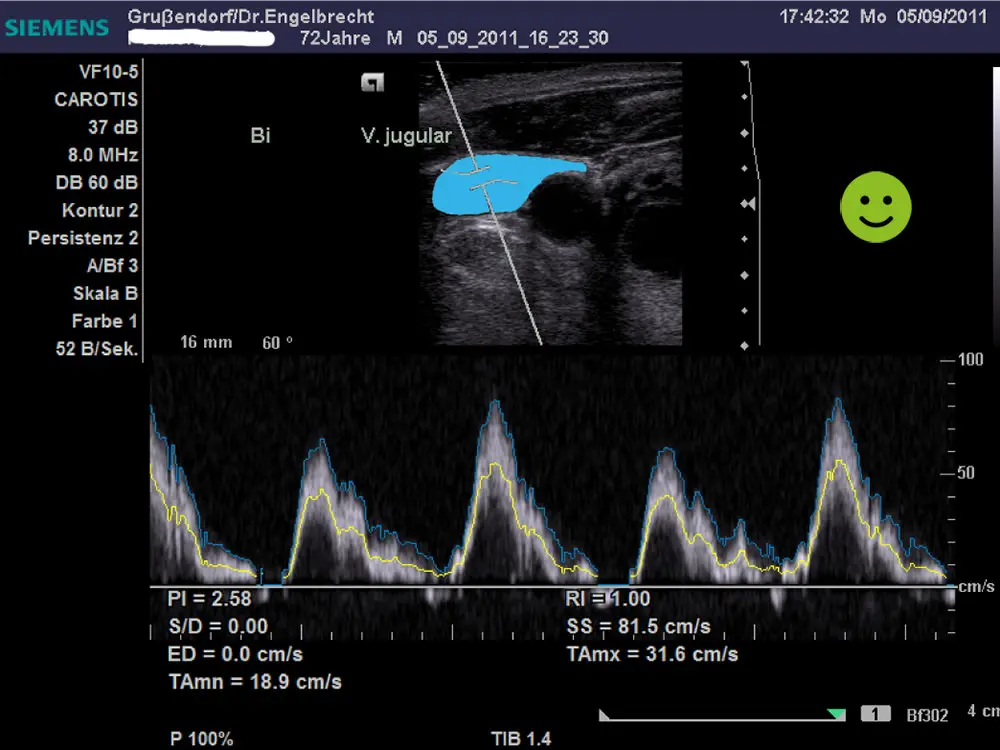 Ecografia della vena giugulare dopo il riallineamento dell'Atlante